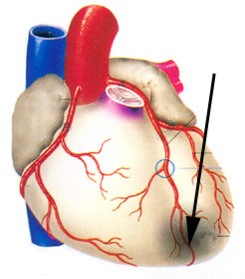 冠心病的危险因素 膳食营养因素与冠心病的关系 第1张